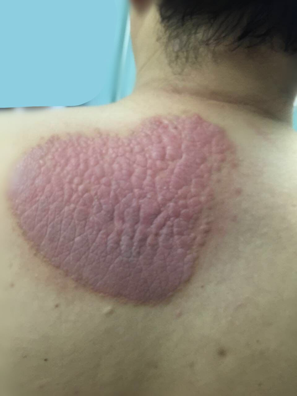 该科接诊医师湛世萍称,这是一种慢性皮肤病,初期表现为异样红肿,瘙痒