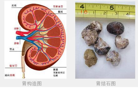泌尿外科主任郭永连介绍,结石可见于肾,膀胱,输尿管和尿道的任何部位